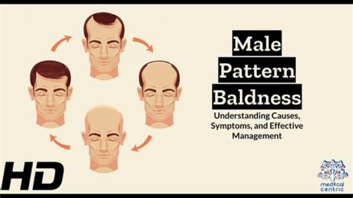 Jacob Batalon's Baldness And The Story Behind It