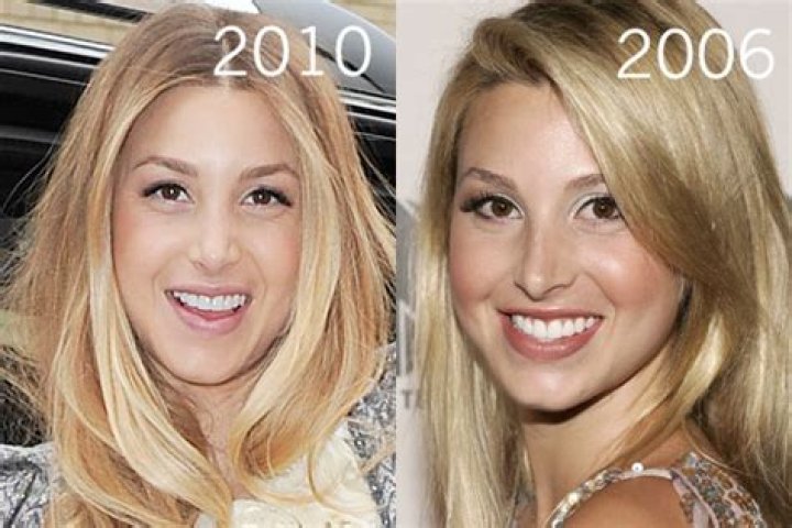 Whitney Port Nose Job: The Ultimate Guide